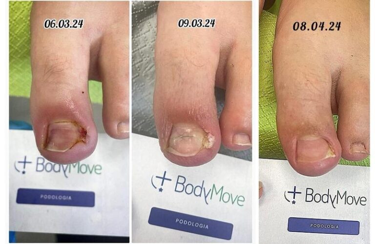 Kiedy wybrać chirurga, a kiedy podologa w przypadku wrastającego paznokcia?