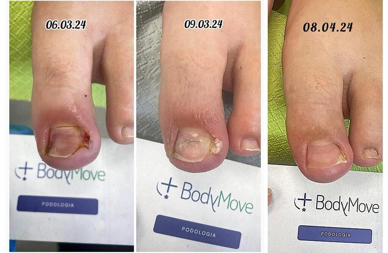 Kiedy wybrać chirurga, a kiedy podologa w przypadku wrastającego paznokcia?