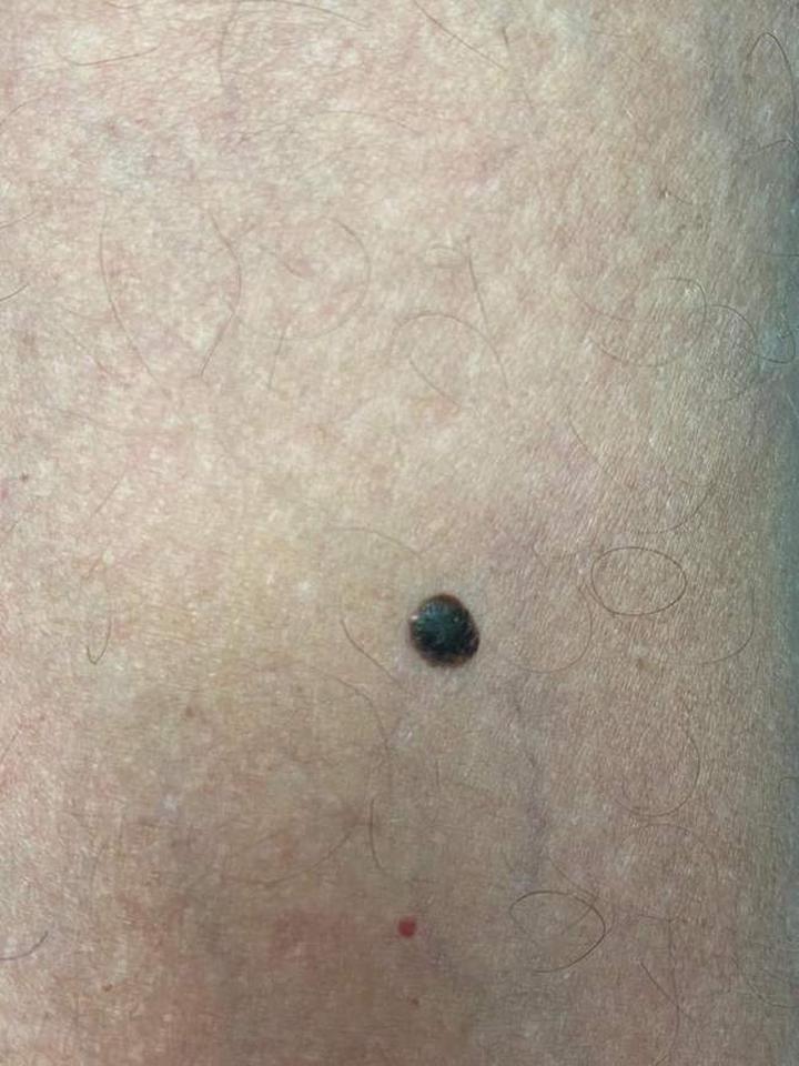 Błędy przy pomiarze brodawki i jak ich unikać