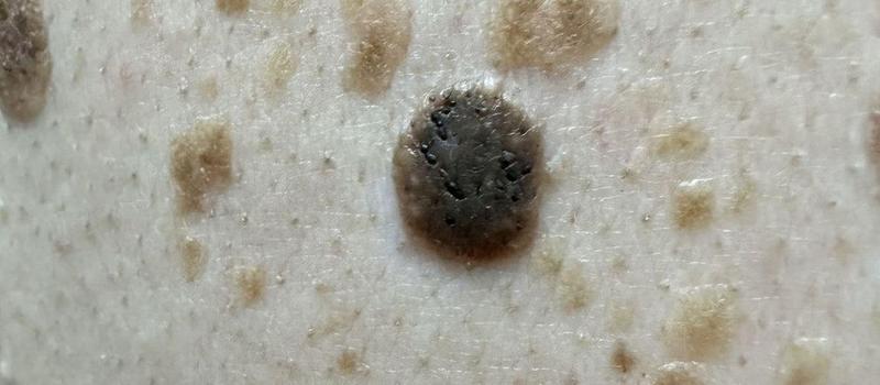 Narzędzia do precyzyjnego pomiaru brodawki