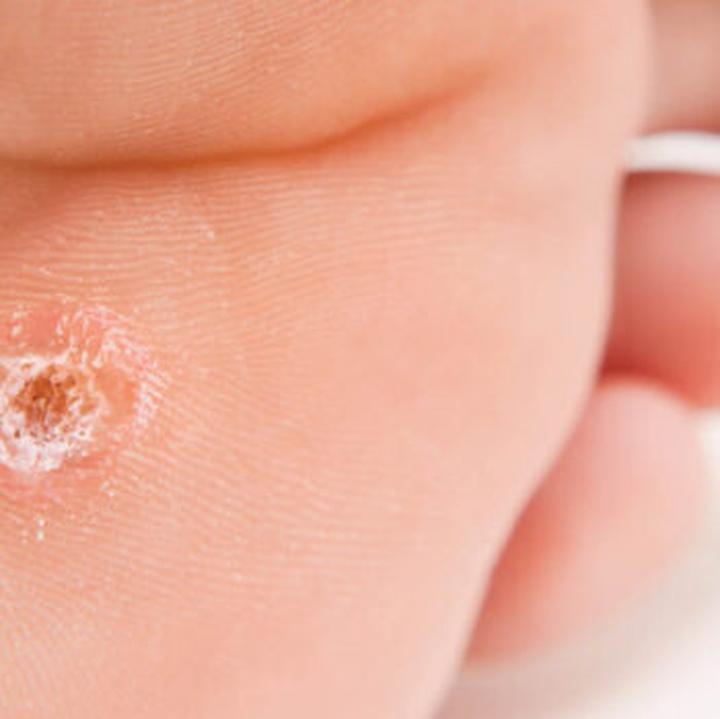 Pomiar rozmiaru brodawki sutkowej